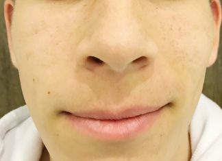 Aknéra hajlamos, de szép bőr? Nem lehetetlen!